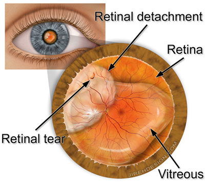 Retinal yırtık Retina dekolmanına neden olabilir