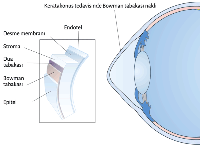 ileri evre Keratakonus tedavisinde dikişli kornea nakline bir alternatif Bowman tabakası nakli